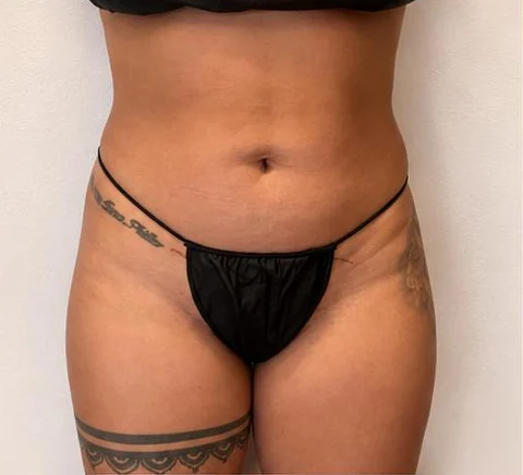 Después de 3 sesiones – Antes · Frontal – Sculptology Málaga