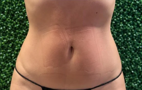 Después de 3 sesiones – Después · Frontal – Sculptology Málaga