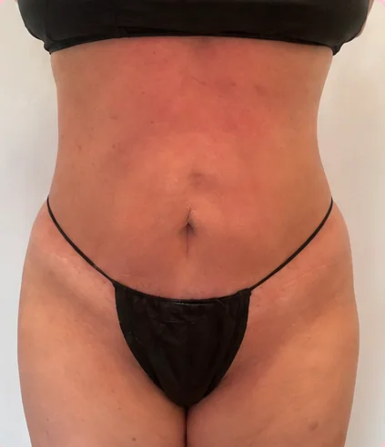 Después de 1 tratamiento – Después · Frontal – Sculptology Málaga