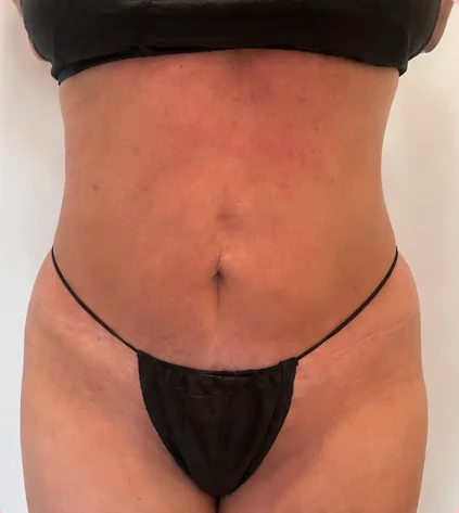 Después de 1 tratamiento – Antes · Frontal – Sculptology Málaga