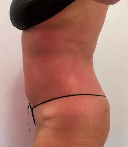 Después de 1 tratamiento – Antes · Lateral – Sculptology Málaga