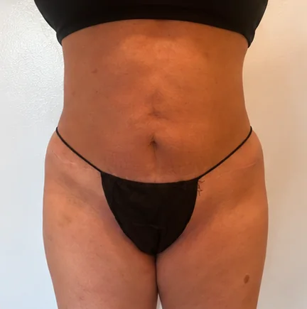 Después de 3 tratamientos – Después · Frontal – Sculptology Málaga