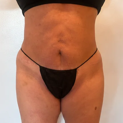 Después de 3 tratamientos – Antes · Frontal – Sculptology Málaga