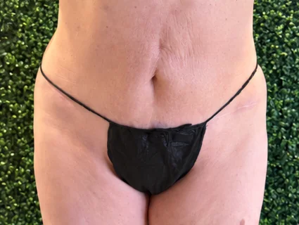 Después de 5 sesiones – Antes · Frontal – Sculptology Málaga