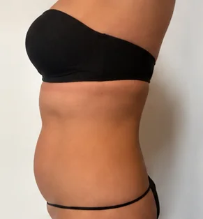 Resultados reales – Antes · Lateral – Sculptology Málaga